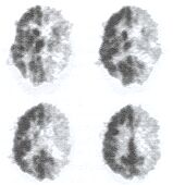 Előrehaladott stádiumú mű Rasmussen-szindróma
jellegzetes agyi glukóz metabolikus képe