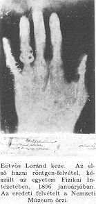 Eötvös Loránd keze; röntgen-felvétel